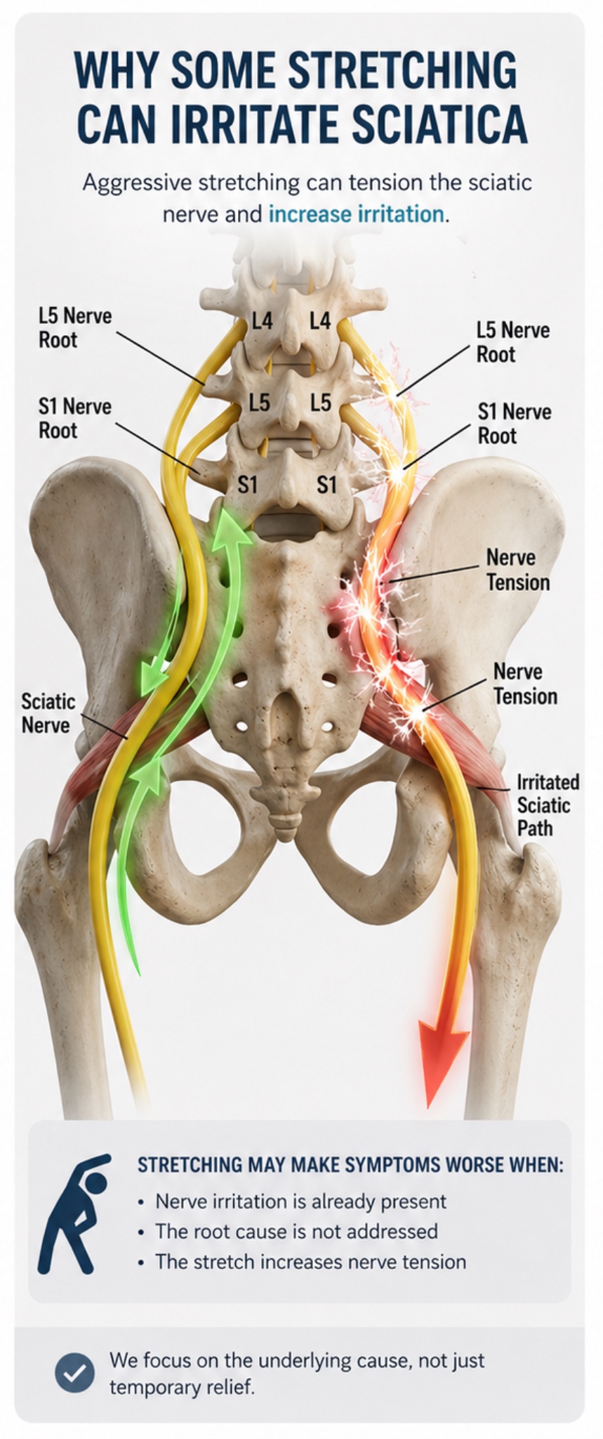 Sciatic nerve irritation causing leg pain and tingling from lower back
